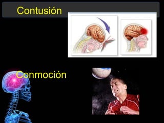Contusión
Conmoción
 