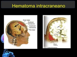 Hematoma intracraneano
 