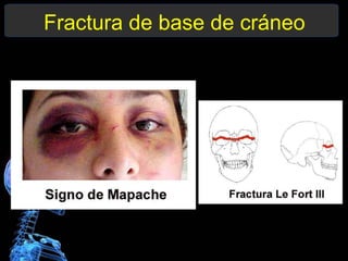 Fractura de base de cráneo
 