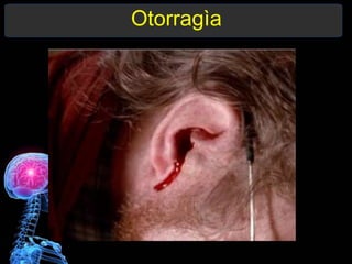 Otorragìa
 