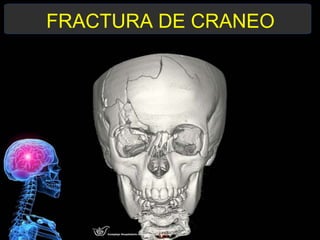 FRACTURA DE CRANEO
 