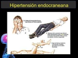 Hipertensión endocraneana
 