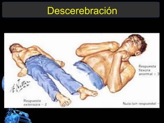 Descerebración
 