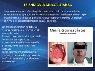 LEISHMANIA MUCOCUTÁNEA
Se presenta meses o años después haber cicatrizado la forma cutánea;
ocasionalmente aparece cuando todavía existen las manifestaciones en la piel.
Posiblemente la infección primaria ha sido inaparente o como una lesión
mínima que pasó desapercibida para el paciente.
Las lesiones se inician en tabique
nasal cartilaginoso y rara vez en el
piso de la nariz.
Pueden comenzar en otras partes de
las vías aéreas superiores.
Al inicio solo hay discreta secreción
de moco, como una rinitis o un
resfriado.
Luego aparece inflamación de la
mucosa, eritema, edema y dolor; la
lesión se profundiza y produce una
pericondritis.
 