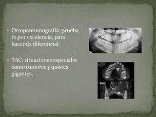  Ortopantomografia: prueba

rx por excelencia, para
hacer dx diferencial.
 TAC: situaciones especiales

como tumores y quistes
gigantes.

 