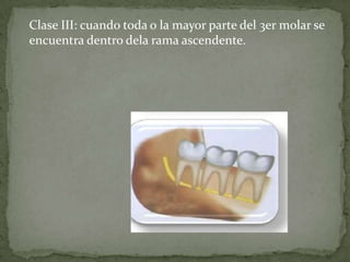 Clase III: cuando toda o la mayor parte del 3er molar se
encuentra dentro dela rama ascendente.

 