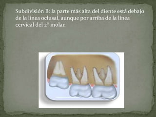 Subdivisión B: la parte más alta del diente está debajo
de la línea oclusal, aunque por arriba de la línea
cervical del 2° molar.

 