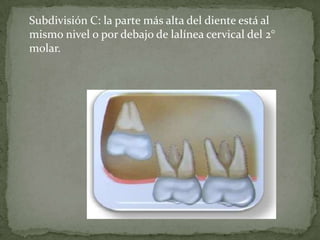 Subdivisión C: la parte más alta del diente está al
mismo nivel o por debajo de lalínea cervical del 2°
molar.

 