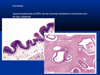 mucinoso
Aproximadamente el 85% de los tumores borderline mucinosos son
de tipo intestinal

 