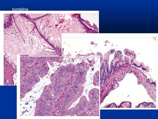 bordeline

 