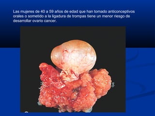 Las mujeres de 40 a 59 años de edad que han tomado anticonceptivos
orales o sometido a la ligadura de trompas tiene un menor riesgo de
desarrollar ovario cancer.

 