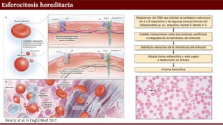 Esferocitosis hereditaria
Rencic et al. N Engl J Med 2017
 