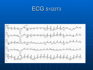 ECG  S1Q3T3 