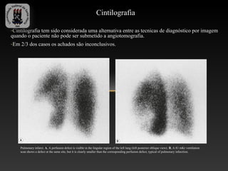 Cintilografia

-Cintilografia tem sido considerada uma alternativa entre as tecnicas de diagnóstico por imagem
quando o paciente não pode ser submetido a angiotomografia.
-Em 2/3 dos casos os achados são inconclusivos.




    Pulmonary infarct. A, A perfusion defect is visible in the lingular region of the left lung (left posterior oblique view). B, A 81 mKr ventilation
    scan shows a defect at the same site, but it is clearly smaller than the corresponding perfusion defect, typical of pulmonary infarction.
 