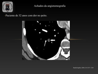 Achados da angiotomografia


-Paciente de 32 anos com dor no peito.




                                                       RadioGraphics 2004; 24:1219 –1238
 