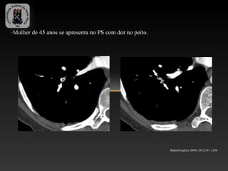 -Mulher de 45 anos se apresenta no PS com dor no peito.




                                                          RadioGraphics 2004; 24:1219 –1238
 
