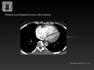 -Homem com dispnéia severa e dor torácica.




                                             RadioGraphics 2004; 24:1219 –1238
 