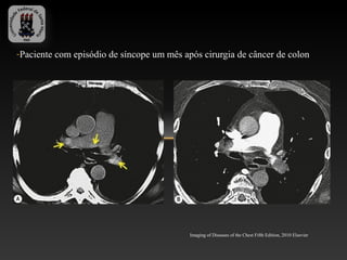 -Paciente com episódio de síncope um mês após cirurgia de câncer de colon




                                           Imaging of Diseases of the Chest Fifth Edition, 2010 Elsevier
 