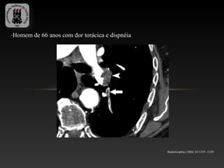 -Homem de 66 anos com dor torácica e dispnéia




                                                RadioGraphics 2004; 24:1219 –1238
 
