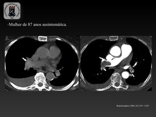 -Mulher de 87 anos assintomática.




                                    RadioGraphics 2004; 24:1219 –1238
 