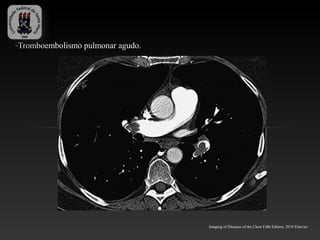 -Tromboembolismo pulmonar agudo.




                                   Imaging of Diseases of the Chest Fifth Edition, 2010 Elsevier
 