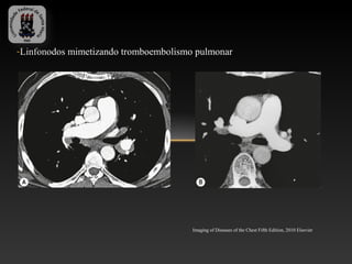-Linfonodos mimetizando tromboembolismo pulmonar




                                       Imaging of Diseases of the Chest Fifth Edition, 2010 Elsevier
 
