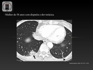-Mulher de 58 anos com dispnéia e dor torácica.




                                                  RadioGraphics 2004; 24:1219 –1238
 