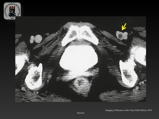 Imaging of Diseases of the Chest Fifth Edition, 2010
Elsevier
 