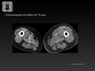 -Venotomografia de mulher de 76 anos.




                                        AJR 2007; 189:156–161
 
