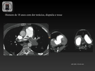 -Homem de 18 anos com dor torácica, dispnéia e tosse




                                                       AJR 2009; 192:654–661
 