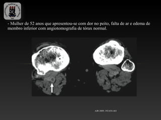 - Mulher de 52 anos que apresentou-se com dor no peito, falta de ar e edema de
membro inferior com angiotomografia de tórax normal.




                                               AJR 2009; 192:654–661
 