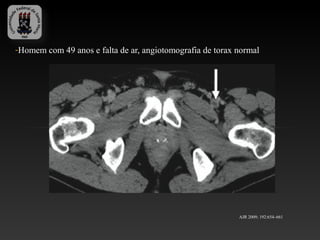-Homem com 49 anos e falta de ar, angiotomografia de torax normal




                                                           AJR 2009; 192:654–661
 