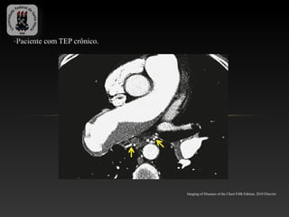 -Paciente com TEP crônico.




                             Imaging of Diseases of the Chest Fifth Edition, 2010 Elsevier
 