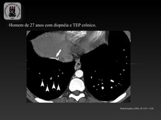 -Homem de 27 anos com dispnéia e TEP crônico.




                                                RadioGraphics 2004; 24:1219 –1238
 
