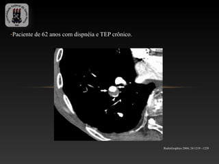 -Paciente de 62 anos com dispnéia e TEP crônico.




                                                   RadioGraphics 2004; 24:1219 –1238
 