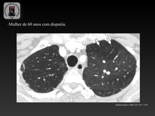 -Mulher de 60 anos com dispnéia.




                                   RadioGraphics 2004; 24:1219 –1238
 