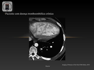 -Paciente com doença tromboembólica crônica




                                               Imaging of Diseases of the Chest Fifth Edition, 2010
                                    Elsevier
 