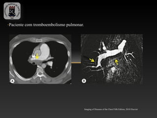 -Paciente com tromboembolismo pulmonar.




                                          Imaging of Diseases of the Chest Fifth Edition, 2010 Elsevier
 