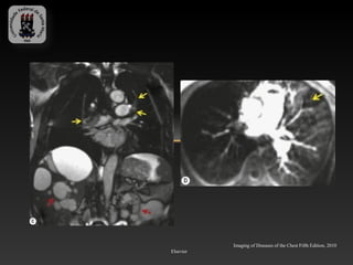 Imaging of Diseases of the Chest Fifth Edition, 2010
Elsevier
 