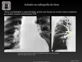 Achados na radiografia de tórax

-Baixa sensibilidade e especificidade, porém tem função de excluir outras condições
que podem simular clinicamente TEP.




               Westermark sign of pulmonary embolism. The right hilum is large, and vessels beyond the
               hilum in the right lower lobe are small.




                                                                                                         Imaging of Diseases
 