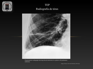 TEP
                     Radiografia de tórax




Posteroanterior radiograph showing discoid atelectasis in a patient with pulmonary
embolism.
                                                                     Imaging of Diseases of the Chest Fifth Edition, 2010 Elsevier
 
