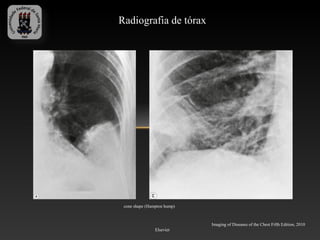 Radiografia de tórax




 cone shape (Hampton hump)



                             Imaging of Diseases of the Chest Fifth Edition, 2010
                Elsevier
 