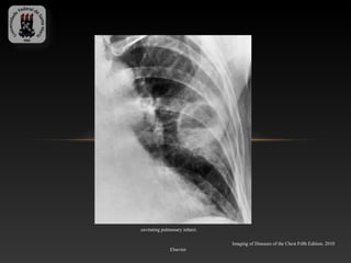 cavitating pulmonary infarct.

                                Imaging of Diseases of the Chest Fifth Edition, 2010
               Elsevier
 