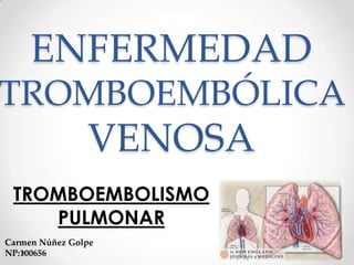 ENFERMEDAD
TROMBOEMBÓLICA
                VENOSA
 TROMBOEMBOLISMO
    PULMONAR
Carmen Núñez Golpe
NP:100656
 