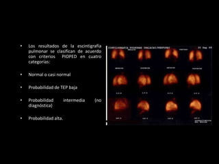 •

Los resultados de la escintigrafía
pulmonar se clasifican de acuerdo
con criterios PIOPED en cuatro
categorías:

•

Normal o casi normal

•

Probabilidad de TEP baja

•

Probabilidad
diagnóstica)

•

Probabilidad alta.

intermedia

(no

 