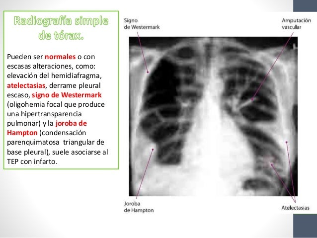 Tromboembolia pulmonar