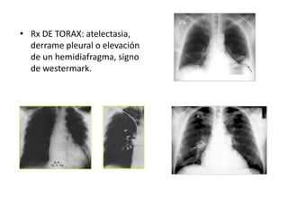 • Rx DE TORAX: atelectasia,
derrame pleural o elevación
de un hemidiafragma, signo
de westermark.
 