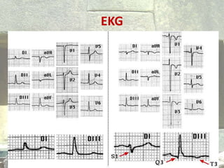 EKG
 