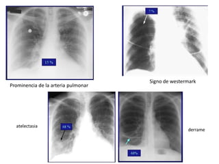 Prominencia de la arteria pulmonar
Signo de westermark
 