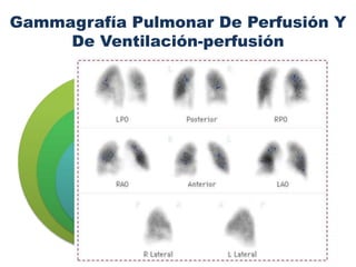 Gammagrafía Pulmonar De Perfusión Y
De Ventilación-perfusión
Se le da a inhalar a paciente xenón radioactivo.
Si el paciente tiene su vía bronquial despejada (ventilación adecuada)
como es en el caso del TEP, el xenón se distribuye en todo el espacio
pulmonar.
Después, con albúmina marcada, se hace un estudio con gama cámara
para evaluar la perfusión pulmonar.
Es altamente sugerente de TEP si las zonas pulmonares que están
ventiladas no están perfundidas, se produce una incongruencia.
debe leerse como normal (prácticamente descarta TEP), anormal
diagnóstica (prácticamente confirma TEP) o anormal no diagnóstica (no
confirma, ni descarta TEP)
 
